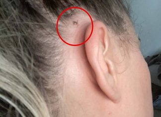 호주 계속해서 내리는 비에 위험한 진드기 경보 Nine.com.au Line-Up Editor Karina Recchi found a tick behind her ear after bushwalking. (9News)