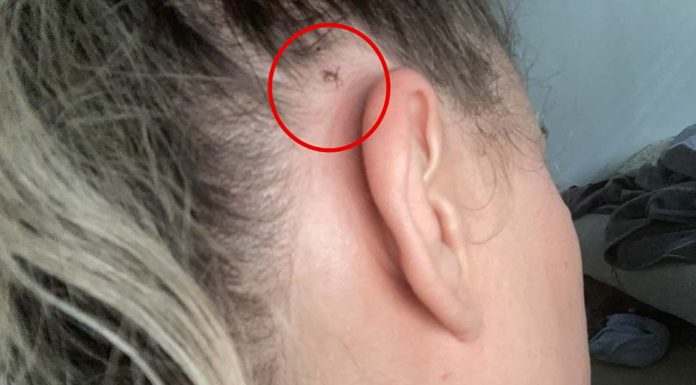 호주 계속해서 내리는 비에 위험한 진드기 경보 Nine.com.au Line-Up Editor Karina Recchi found a tick behind her ear after bushwalking. (9News)