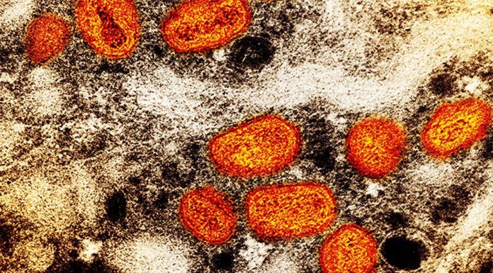 NSW 원숭이 두창 첫 지역 감염 사례 등장 The monkeypox virus can spread through contact with body fluids, sores or items such as clothing and bedding contaminated with the virus. It can also spread from person to person through respiratory droplets, typically in a close setting. (AP)