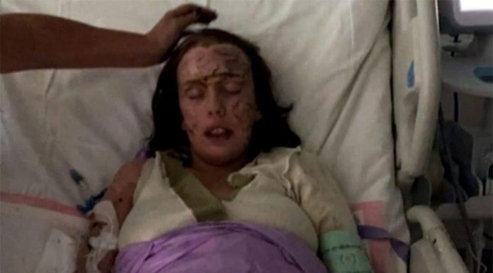 e-스쿠터 배터리 화재로 파트너를 잃은 여성, 리튬이온 배터리의 위험성 경고 Willis, who was pregnant at the time, sustained burns to more than 80 per cent of her body. (9News)