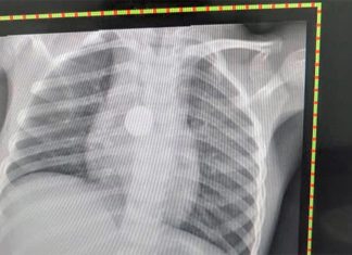 호주 판매 중인 버튼형 배터리, 3개 중 1개, 안전 기준 충족 못해 Small, round and easily swallowed by young children, a button battery can burn through a child's tissue and seriously damage vital organs. (Supplied)