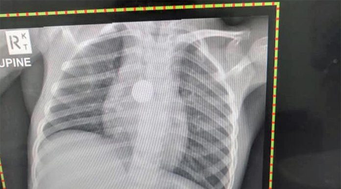 호주 판매 중인 버튼형 배터리, 3개 중 1개, 안전 기준 충족 못해 Small, round and easily swallowed by young children, a button battery can burn through a child's tissue and seriously damage vital organs. (Supplied)