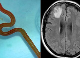 호주, 세계 최초 뇌에서 살아있는 벌레 발견 The Ophidascaris robertsi roundworm larvae, left, and the results of an MRI scan showing it in the Australian woman's brain. (Canberra Health) (Supplied)