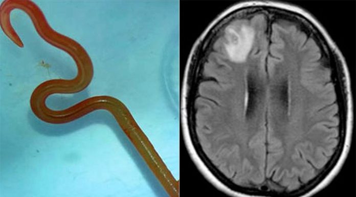 호주, 세계 최초 뇌에서 살아있는 벌레 발견 The Ophidascaris robertsi roundworm larvae, left, and the results of an MRI scan showing it in the Australian woman's brain. (Canberra Health) (Supplied)