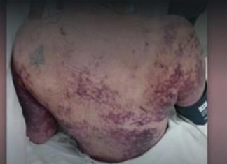 퍼스 여성, 개에게 물려 감염 돼 사망 Tracy was diagnosed with Capnocytophaga canimorsus after a friend’s young dog “accidentally bit her finger instead of a toy”. (Picture 9News)