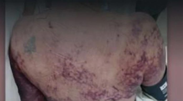 퍼스 여성, 개에게 물려 감염 돼 사망 Tracy was diagnosed with Capnocytophaga canimorsus after a friend’s young dog “accidentally bit her finger instead of a toy”. (Picture 9News)