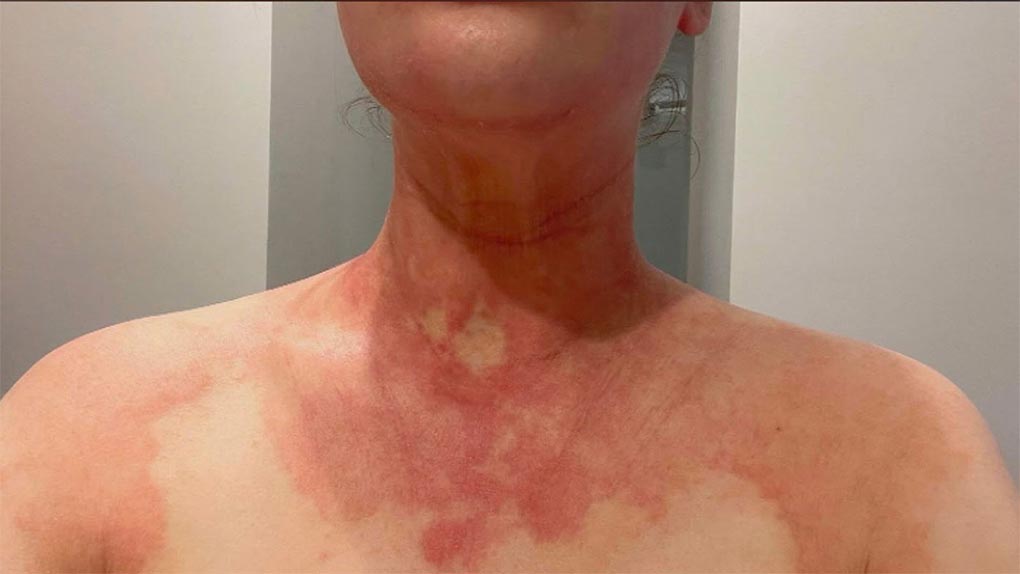 Other residents say their severe rashes are linked to the fumes, and nearly 25,000 complaints have been lodged. (9News)
