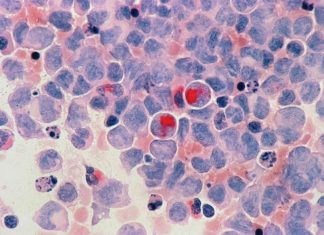 45세이하 호주 여성 혀암 발병 증가 National Cancer Insutitute-nci_Unsplash