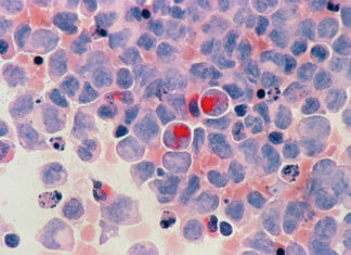 NSW 피부암 환자의 병원을 상대로 한 싸움 national cancer institute_nci_unsplash