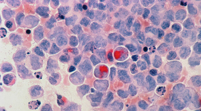 NSW 피부암 환자의 병원을 상대로 한 싸움 national cancer institute_nci_unsplash