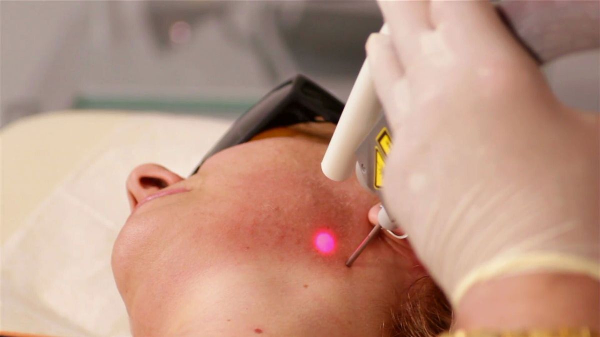 Dermatologists are concerned the largely unregulated procedure is covering up the signs of something more sinister. (9News)