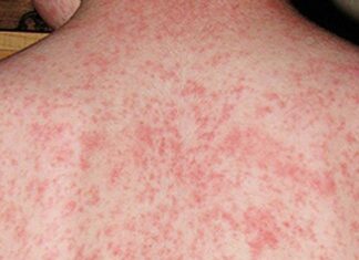 홍역 여행자, 시드니 여러 장소 방문 후 건강 경고 발령 Sydney locals have been urged to be on the lookout for symptoms if they were in the same areas as the traveller. (NSW Health)
