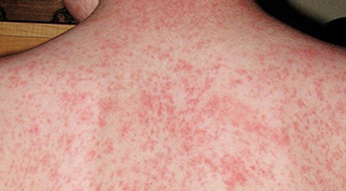 홍역 여행자, 시드니 여러 장소 방문 후 건강 경고 발령 Sydney locals have been urged to be on the lookout for symptoms if they were in the same areas as the traveller. (NSW Health)