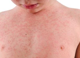 NSW, VIC 새로운 홍역 경고 발효 Symptoms can develop up to 18 days after exposure and is often characterised by a red rash which starts on the head or faces and moves down the body. (iStock)