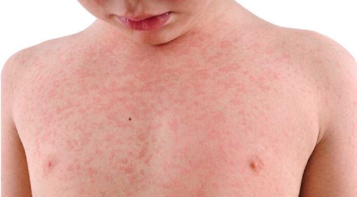 NSW, VIC 새로운 홍역 경고 발효 Symptoms can develop up to 18 days after exposure and is often characterised by a red rash which starts on the head or faces and moves down the body. (iStock)