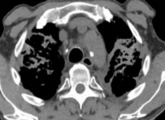 시드니 연구자들 실리코시스(만성 폐질환) 조기 발견 검사 개발 CT scans of a tunneller diagnosed with silicosis. The light grey areas at the top part of the lungs represent severe scar-tissue.UNSW SydneyDeborah Yates (UNSW SydneyDeborah Yates)