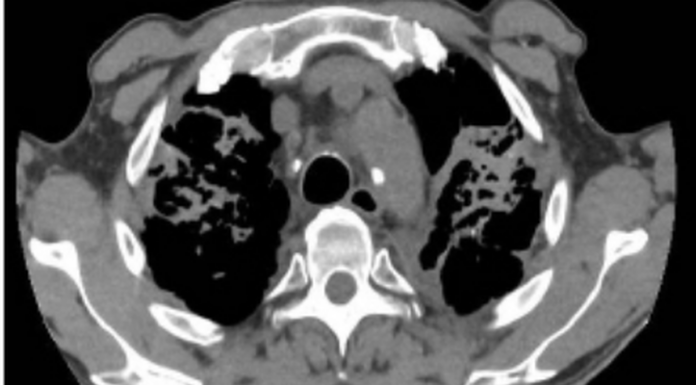 시드니 연구자들 실리코시스(만성 폐질환) 조기 발견 검사 개발 CT scans of a tunneller diagnosed with silicosis. The light grey areas at the top part of the lungs represent severe scar-tissue.UNSW SydneyDeborah Yates (UNSW SydneyDeborah Yates)