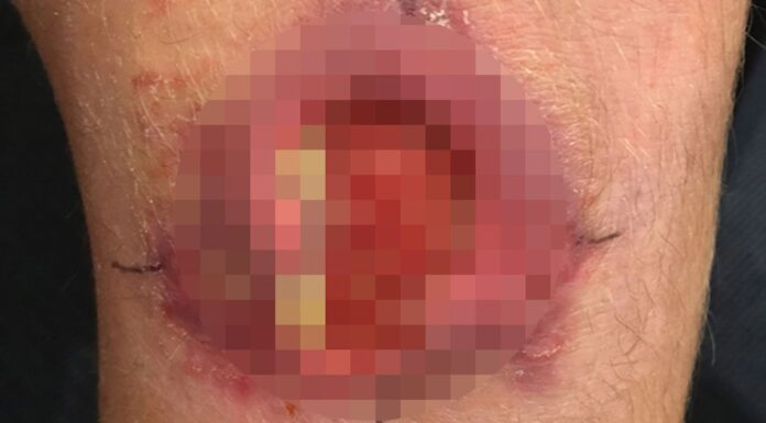남부 NSW 희귀한 육식성 감염 발견돼 경고 발령 Buruli ulcer is a skin infection caused by the bacterium Mycobacterium ulcerans. (AAP)
