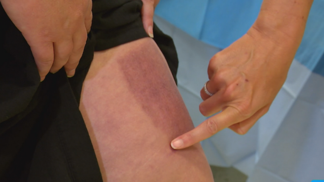 She agreed to be the first patient in the world to receive 3D-printed skin to repair her graft site. (Nine)