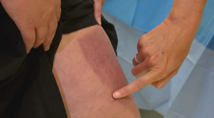 호주 시드니 병원, 세계 최초로 화상 환자에게 3D 프린팅 피부 이식 성공 She agreed to be the first patient in the world to receive 3D-printed skin to repair her graft site. (Nine)