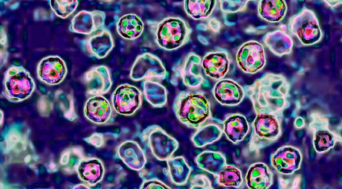 시드니 항공에 홍역 감염자 입국 NSW 보건 당국 경고 The measles virus, paramyxoviridae from the Morbillivirus family, transmission microscopy view. (BSIPUniversal Images GroupGettyCNN)