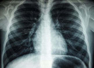 호주 여성 유방암 검사 후 1,400달러의 청구서에 충격 Unsplash의Umanoide