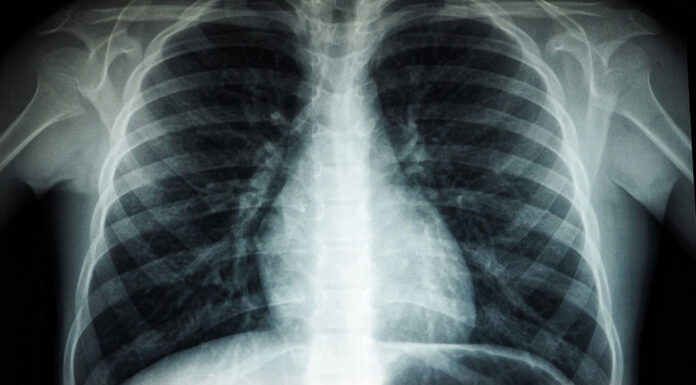 호주 여성 유방암 검사 후 1,400달러의 청구서에 충격 Unsplash의Umanoide