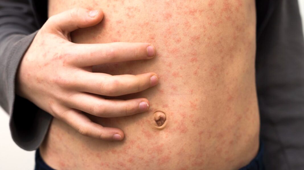 A new measles alert has been issued for Sydney. Credit Getty Images_7news