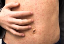 시드니, 홍역 추가 확진 2건 발생 A new measles alert has been issued for Sydney. Credit Getty Images_7news