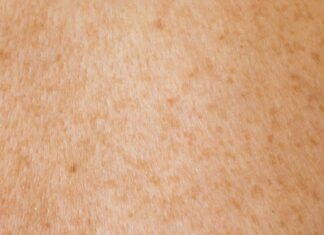 예방 가능한 암 중 호주인 발생율 높은 암은? Olga Thelavart_olga_o_unsplash