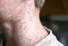 시드니 홍역 확산 우려 증가 Measles can lead to a large rash on a persons body, especially on the neck or limbs. (Getty)_9news