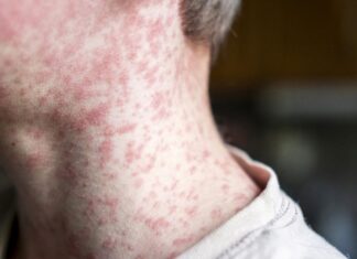 시드니 홍역 확산 우려 증가 Measles can lead to a large rash on a persons body, especially on the neck or limbs. (Getty)_9news