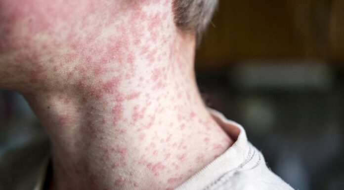 시드니 홍역 확산 우려 증가 Measles can lead to a large rash on a persons body, especially on the neck or limbs. (Getty)_9news