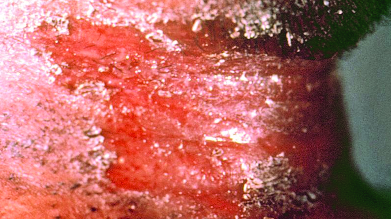 Diphtheria can also infection the skin, causing infectious lesions. (CDC), 9news