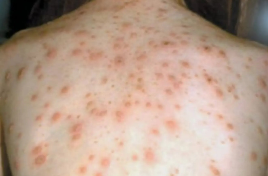 The person had returned from South East Asia, where there are ongoing outbreaks of measles. Supplied_9NEWS