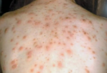 시드니 홍역 경고…감염자·콩코드 캠벨타운·나렐란 등 방문 The person had returned from South East Asia, where there are ongoing outbreaks of measles. Supplied_9NEWS