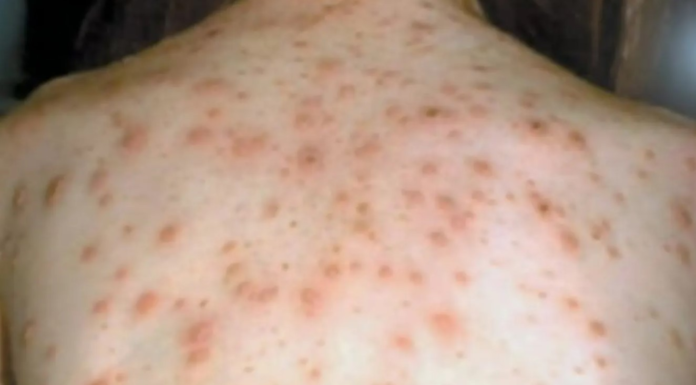 시드니 홍역 경고…감염자·콩코드 캠벨타운·나렐란 등 방문 The person had returned from South East Asia, where there are ongoing outbreaks of measles. Supplied_9NEWS